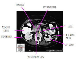 Labeled Abdominal Ct