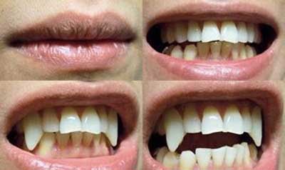 teeth grinding picdump acid implants 2007 tooth crowns temporary site wired recession grow sharp furry p566