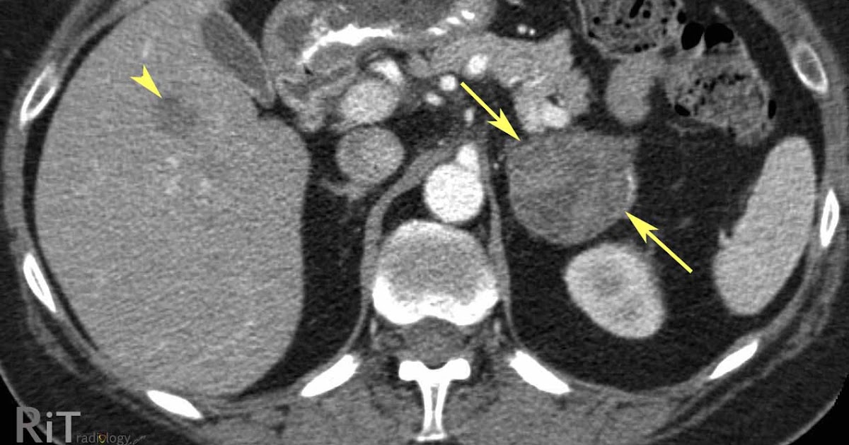 RiT radiology Adrenal Cortical Carcinoma
