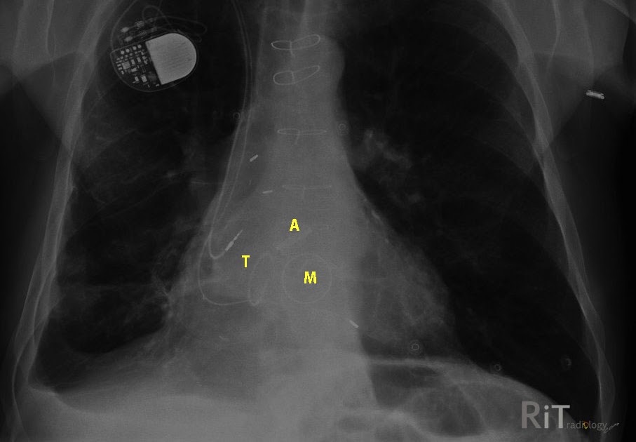 RiT radiology Anatomic Position of Heart Valves