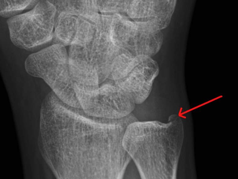 RiT radiology Isolated Ulnar Styloid Process Fracture
