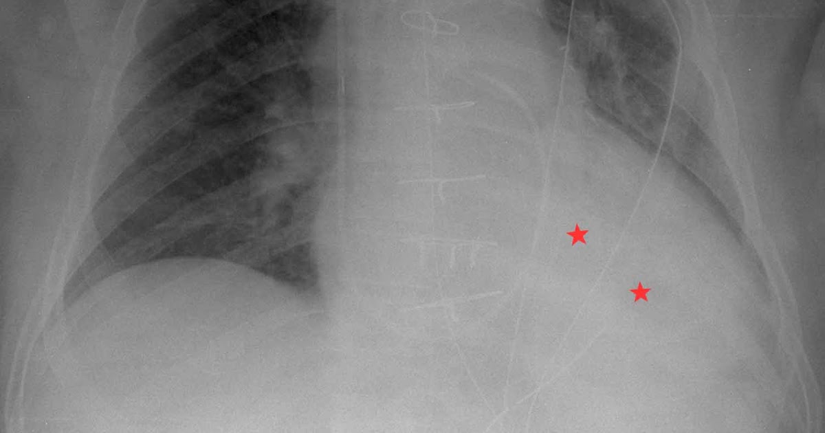 RiT radiology Large Pleural Effusion Following CABG