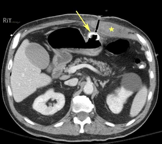 RiT radiology Rectus Sheath Hematoma Following PEG Placement