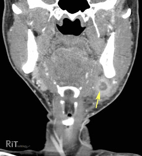 RiT radiology: Submandibular Sialadenitis with Abscess