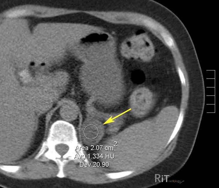adrenal mass ct with or without contrast