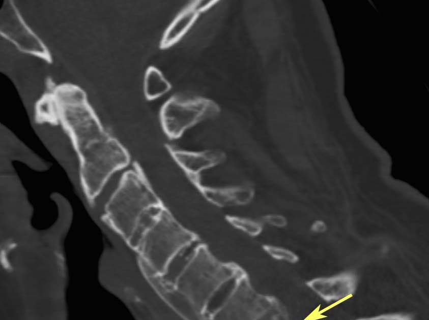 RiT radiology Spinal Fracture in Ankylosing Spondylitis