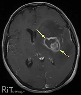 Parasite In Brain From Cat Litter Parasite In Brain From Cat Litter