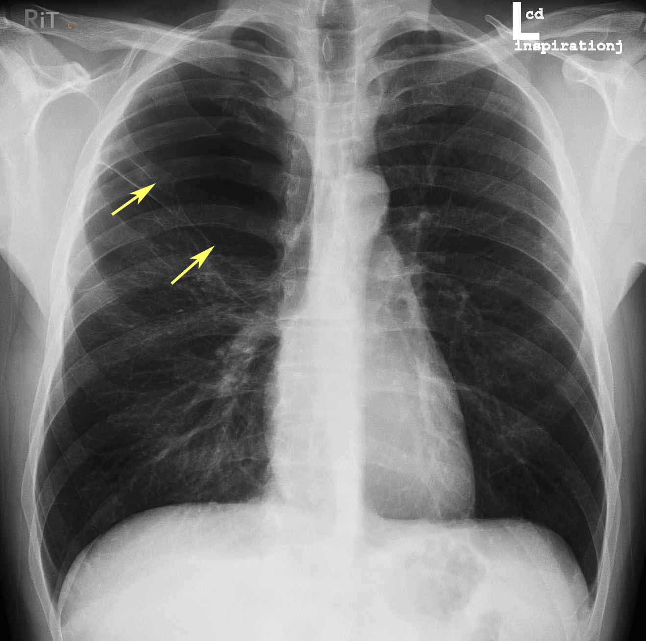 Signs And Symptoms Of Large Pneumothorax