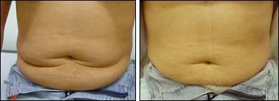 carboxiterapia barriga