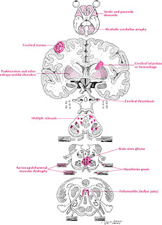 brain dysarthria diagram patient