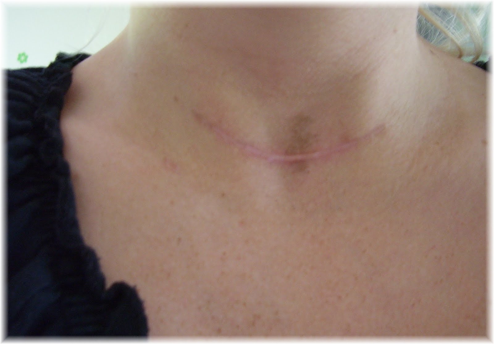 Life After Thyroid Cancer Scar Today