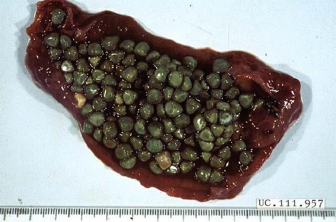 Cystic Duct Obstruction