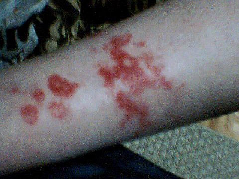 [bed-bug-bites-01.jpg]