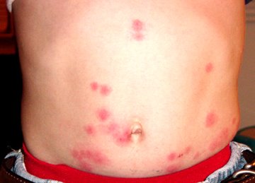 [bed-bug-bites-02.jpg]