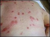 [bed-bug-bites-04.jpg]