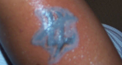 Tca Tattoo Removal Before And After Pictures - Tattoo's Imagine