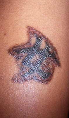 I Am...LondonDiva: Tattoo Removal With TCA [Chemical Peel]
