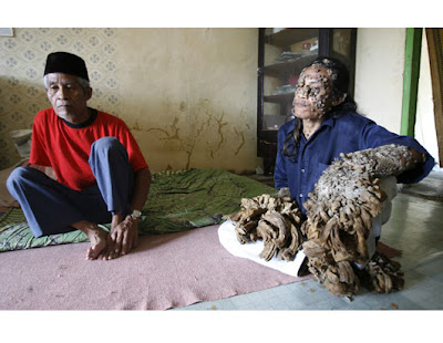 tree man after surgery. Hands andindonesian man Tree