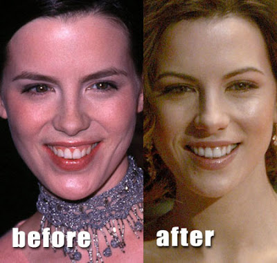 Nose Plastic Surgery on Pics Blogspot Com  Celebs Before And After Nose Plastic Surgery