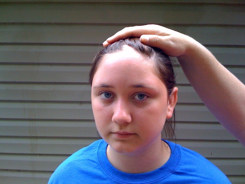 Dent in the middle of my forehead daypassa