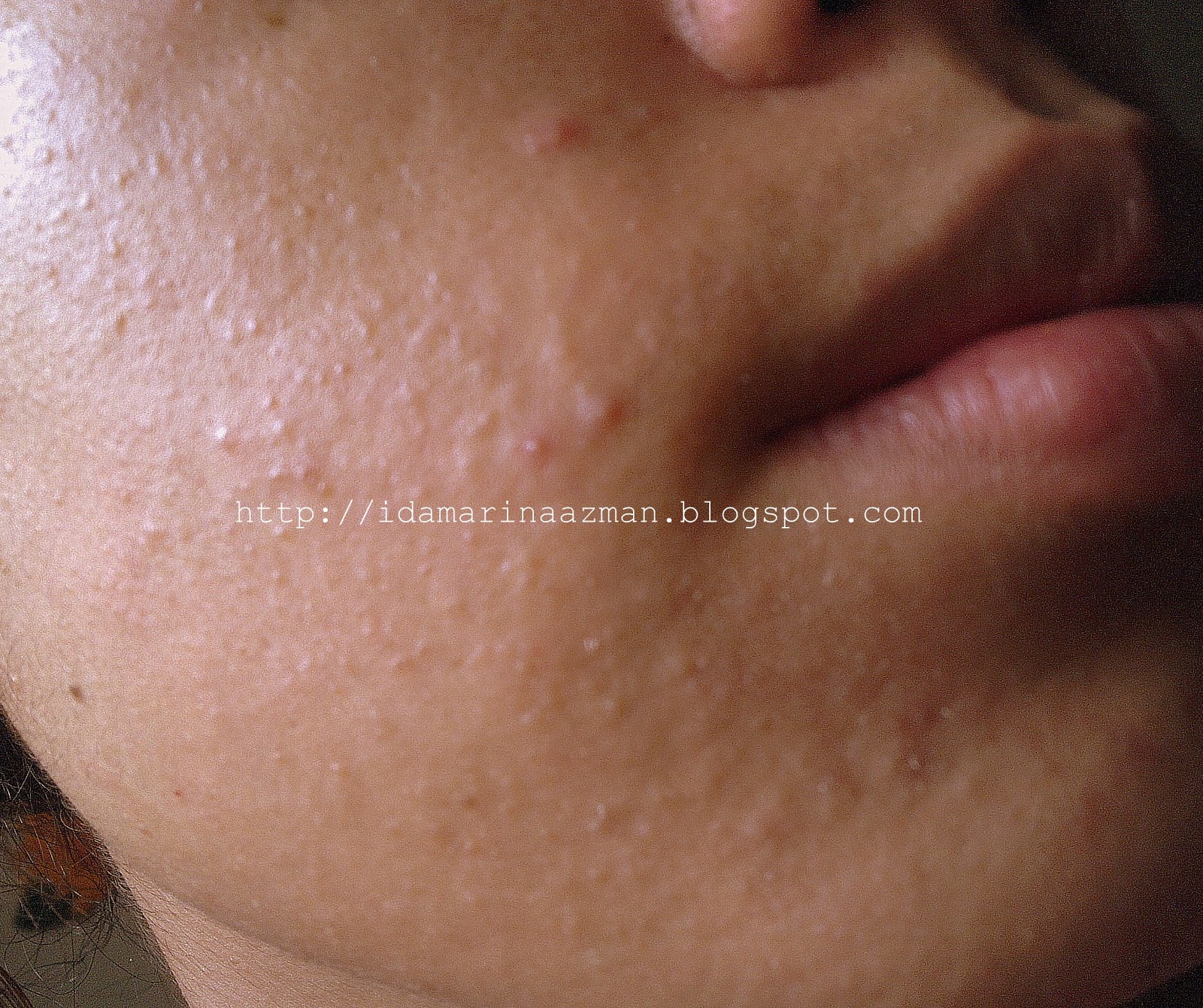 acne how to get rid of