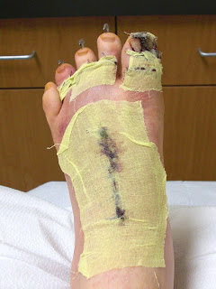 Hammertoe