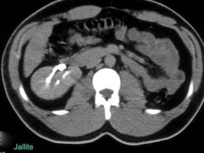 agenesia renal