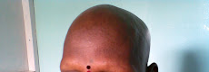Alopecia Areate- UndregoingTreatment