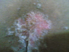 Eczema-Before Treatment