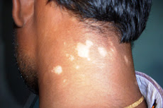 Leucoderma - Before Treatment