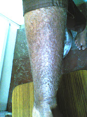 Eczema-Before Treatment