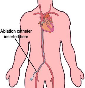 Cardiac ablation involves