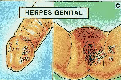 ENFERMEDAD VENEREAS EN EL HOMBRE enfermedad venereas en el hombre: