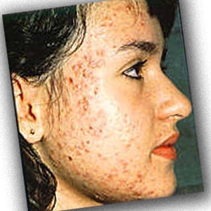 Tazorac For Acne Scars Tazorac For Acne Scars