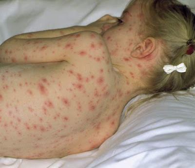 Description: The highest incidence of chickenpox has recently been among