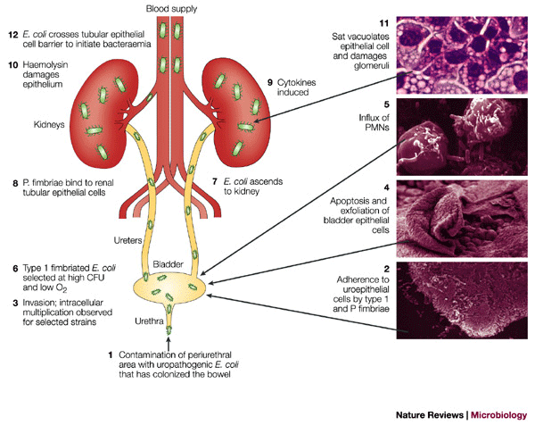 Uraniry tract infection
