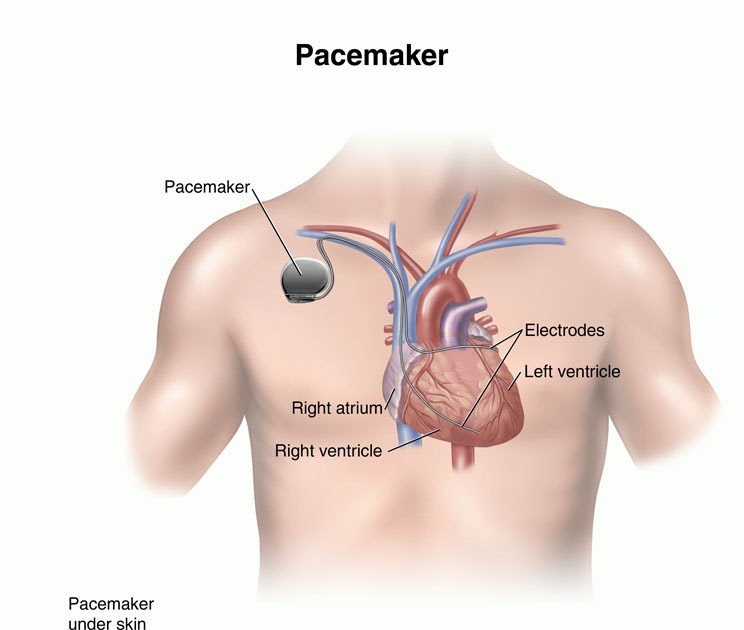 Science Implantation of Pacemakers