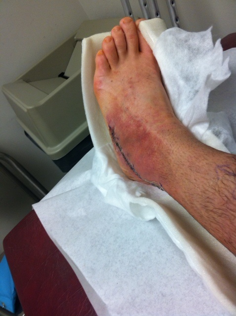 My Peroneal Tendon Surgery and Recovery
