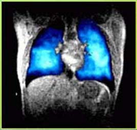 Lungs Mri