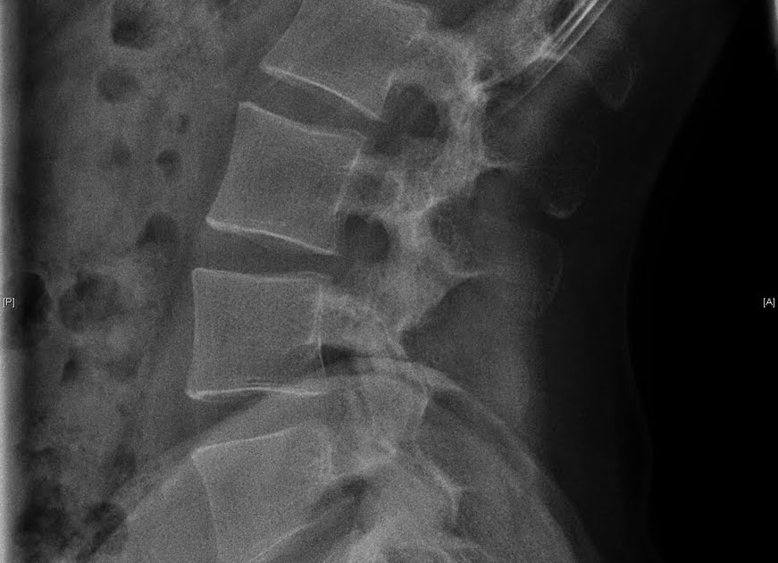 Freedomvox: My Lumbar Lordosis