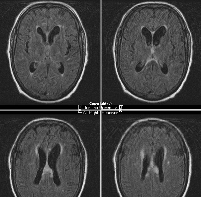 Neuroradiology On the Net Cryptococcal meningitis