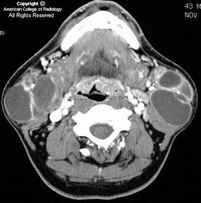 Neuroradiology On the Net: Benign lymphoepithelial cysts of parotid