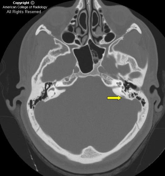 enlarged vestibular aqueduct syndrome - meddic