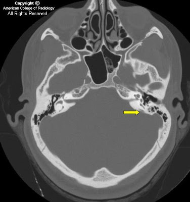 Neuroradiology On the Net: Enlarged vestibular aqueduct