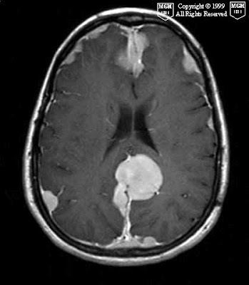 Neuroradiology On the Net: Multiple meningiomas in Neurofibromatosis Type 2