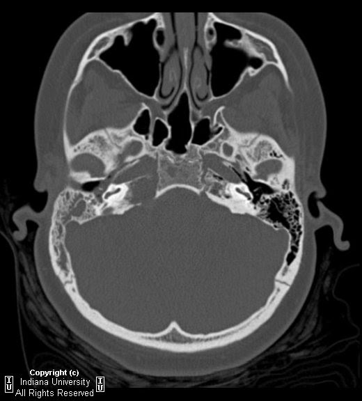 Neuroradiology On the Net: Right petrous apicitis (Gradenigo's syndrome