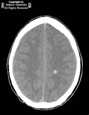 Neuroradiology On the Net: Cavernous malformations