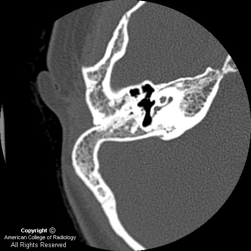 Neuroradiology On the Net: Microtia