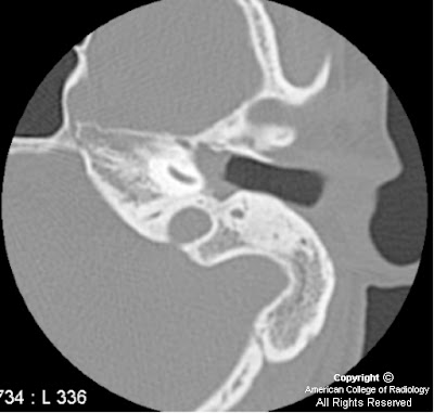 Cholesteatoma+on+mri