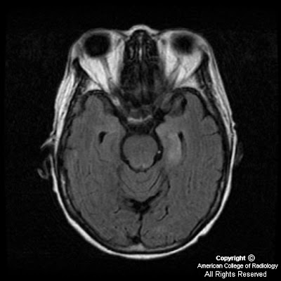 Limbic Encephalitis